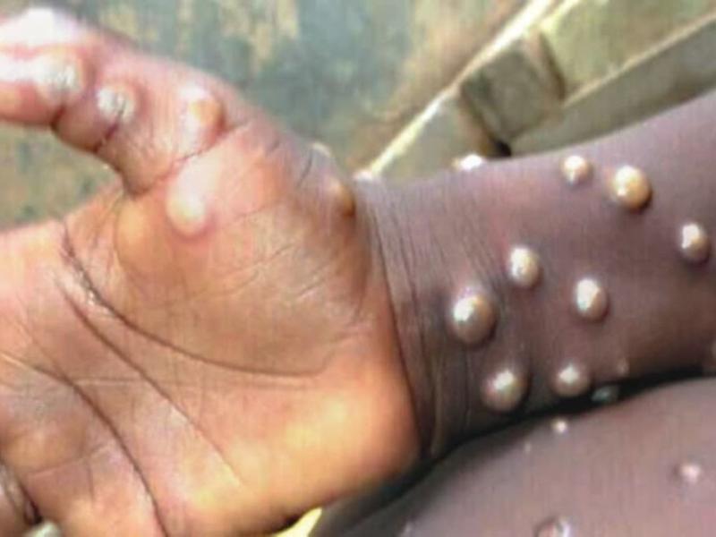 Personne atteinte de l'épidémie de Monkey pox