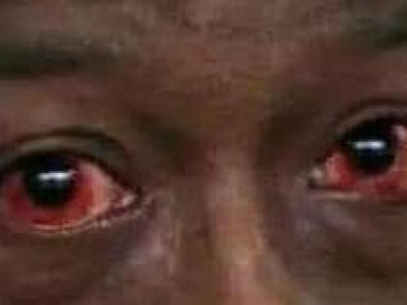 Les yeux d'une personne atteinte de la conjonctivite allergique