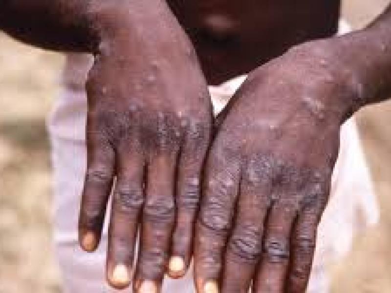 Les mains d'une personne atteinte de la maladie virale de singe.