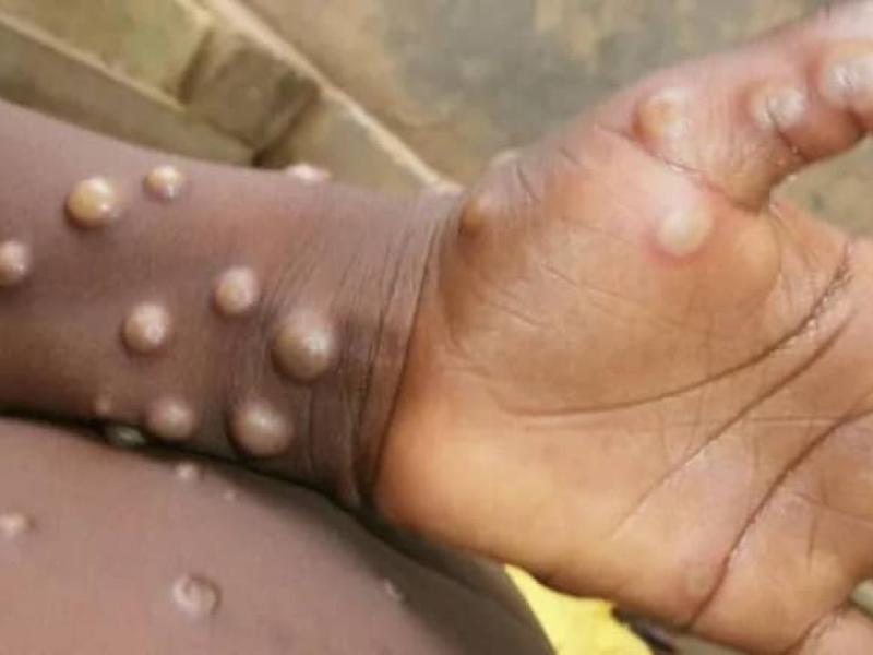 Une personne atteinte par la variole du singe [photo d'illustration]