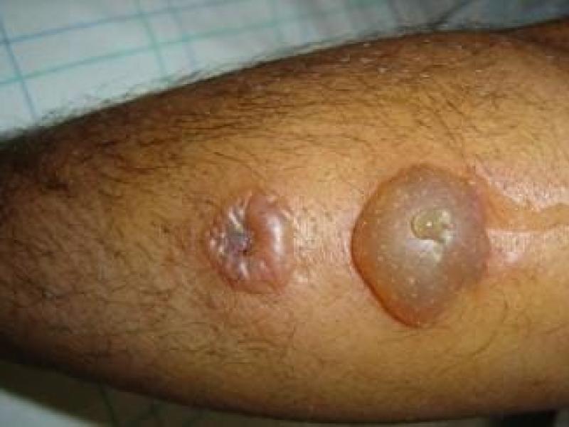Une personne atteinte par la maladie du charbon cutanée, dit Anthrax [photo d’illustration]