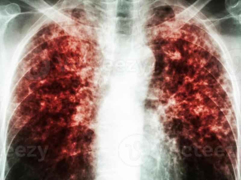 Résultats radiophoniques d’une personne frappée par la tuberculose pulmonaire [photo d’illustration]