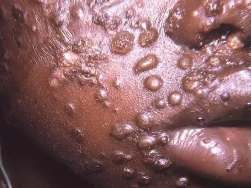 Un enfant souffrant de variole du signe (image d’illustration)