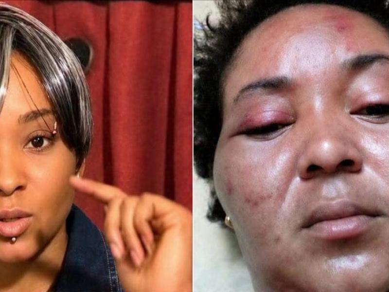 Une femme victime, avant et après l’agression physique de son mari.