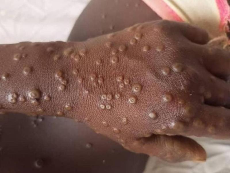 Un enfant atteint de la Mpox