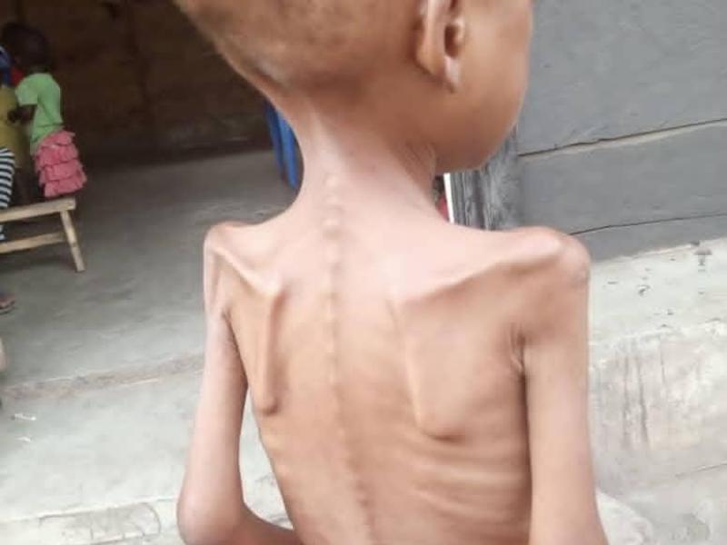 Un enfant orphelin vivant avec la malnutrition à Kasindi-Lubirihya dans l'orphelinat Tukinge Yatima