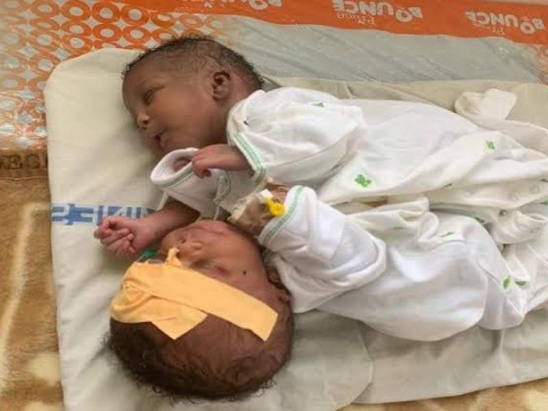 Des bébés siamois [photo d'illustration]
