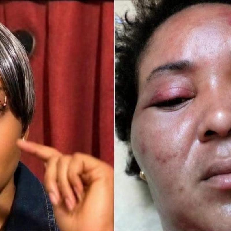 Une femme victime, avant et après l’agression physique de son mari.