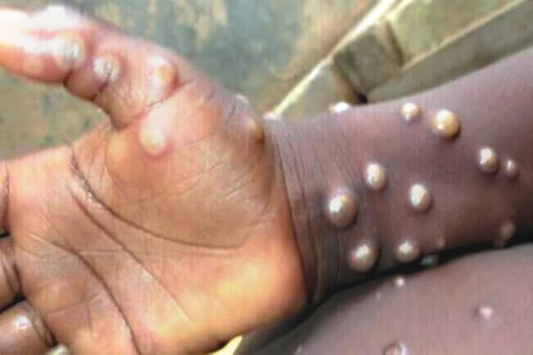 Personne atteinte de l'épidémie de Monkey pox