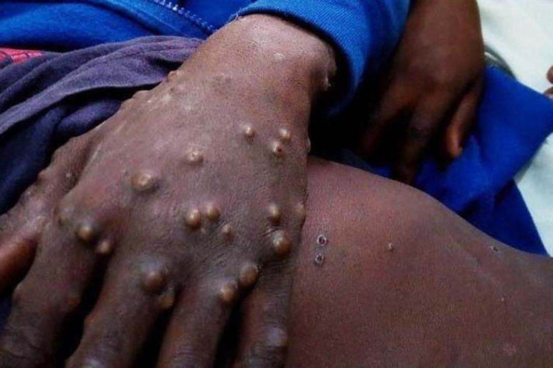 Personne atteinte de la variole du singe