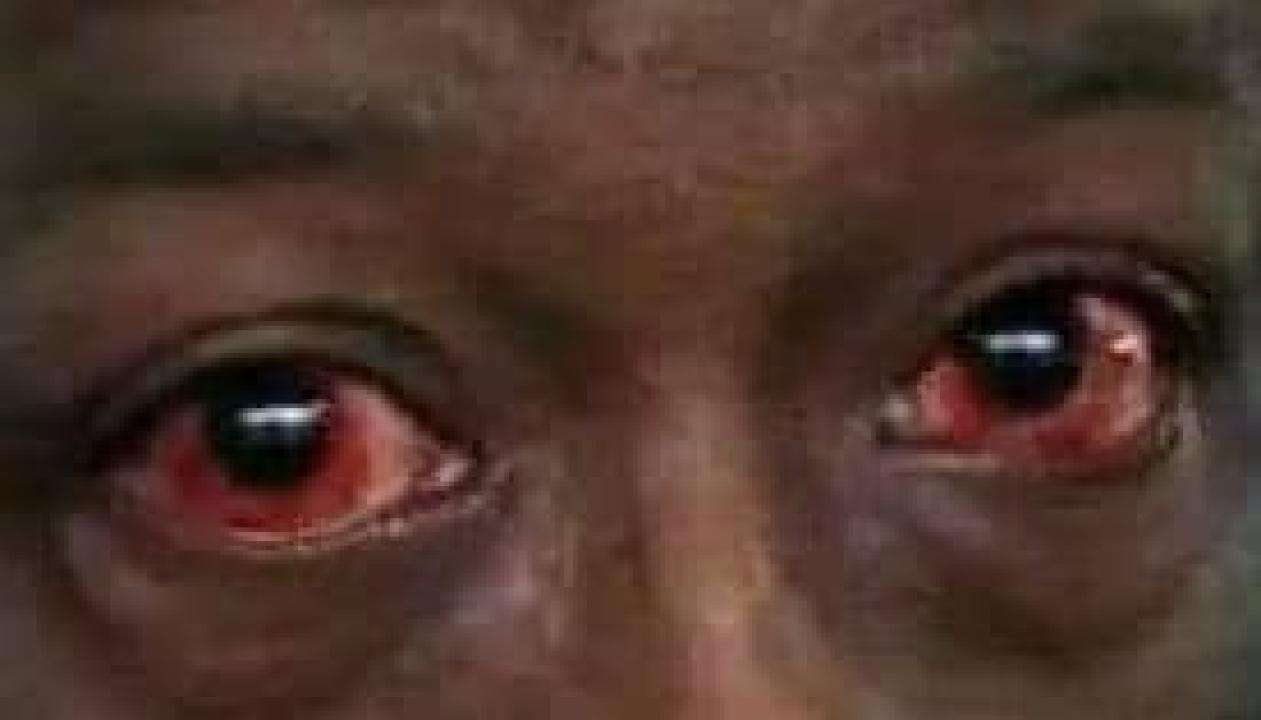 Les yeux d'une personne atteinte de la conjonctivite allergique