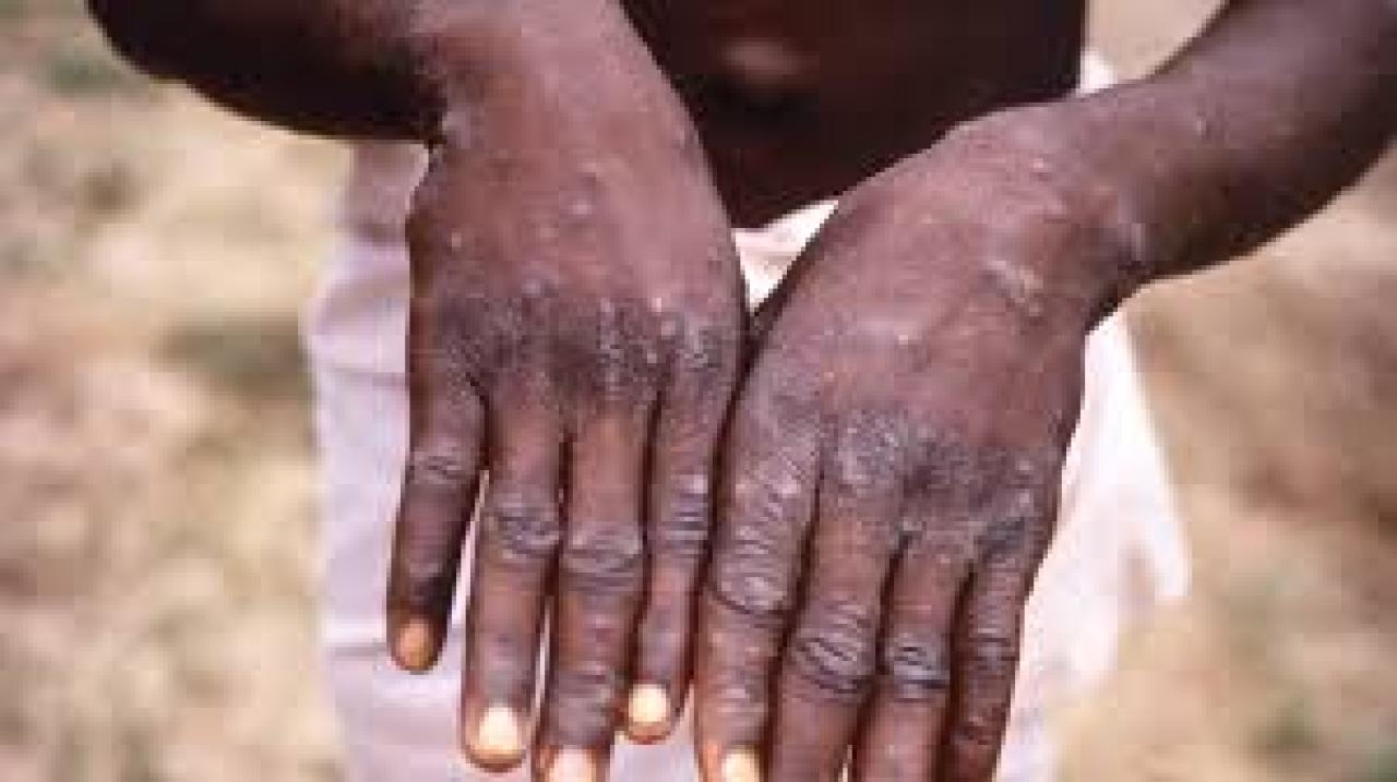 Les mains d'une personne atteinte de la maladie virale de singe.