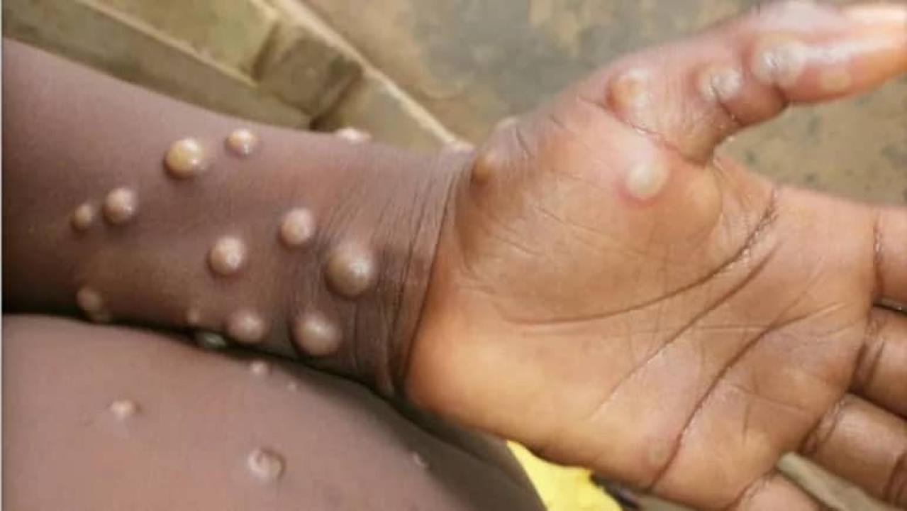 Une personne atteinte par la variole du singe [photo d'illustration]