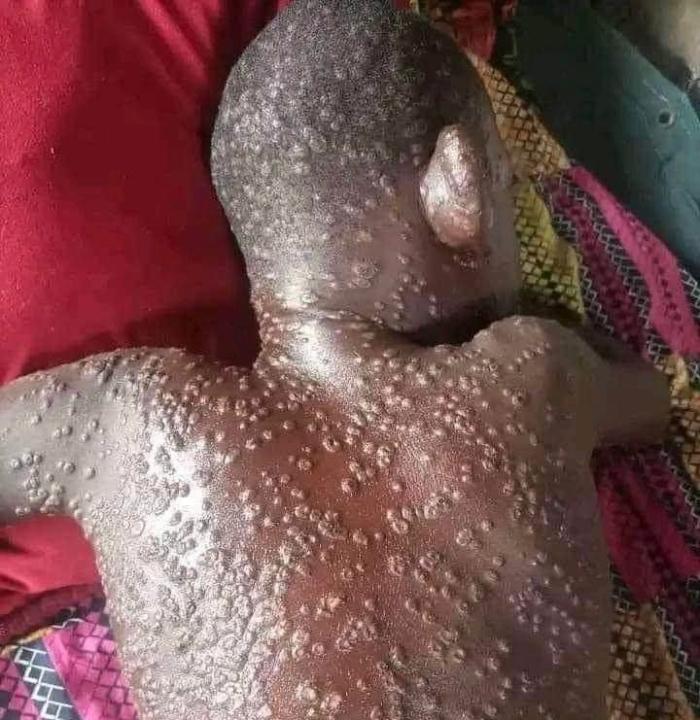 Un enfant frappé par l’épidémie de Mpox (Photo d’illustration)