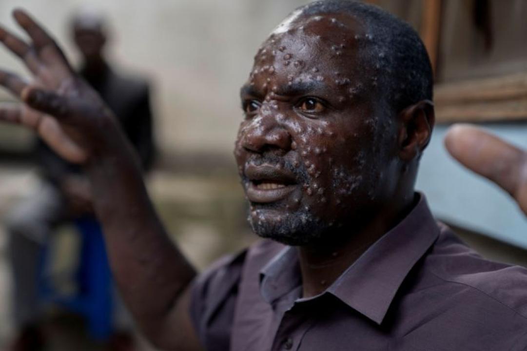 Un habitant de Goma touché par l'épidémie du Mpox. [Photo d'illustration]