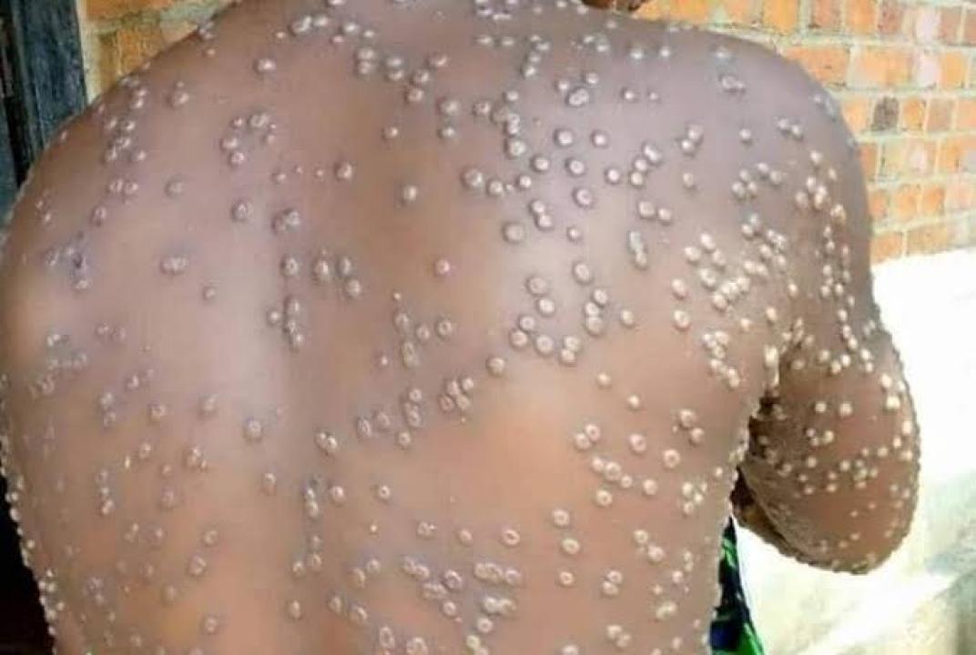 Maladie de Mpox