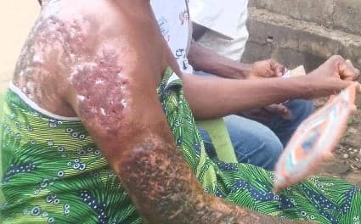 L’une des femmes victimes des atrocités des miliciens Mobondo dans la province de Maï-Ndombe [photo d’illustration]