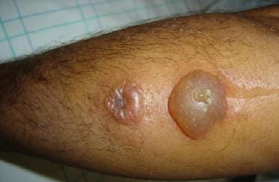 Une personne atteinte par la maladie du charbon cutanée, dit Anthrax [photo d’illustration]