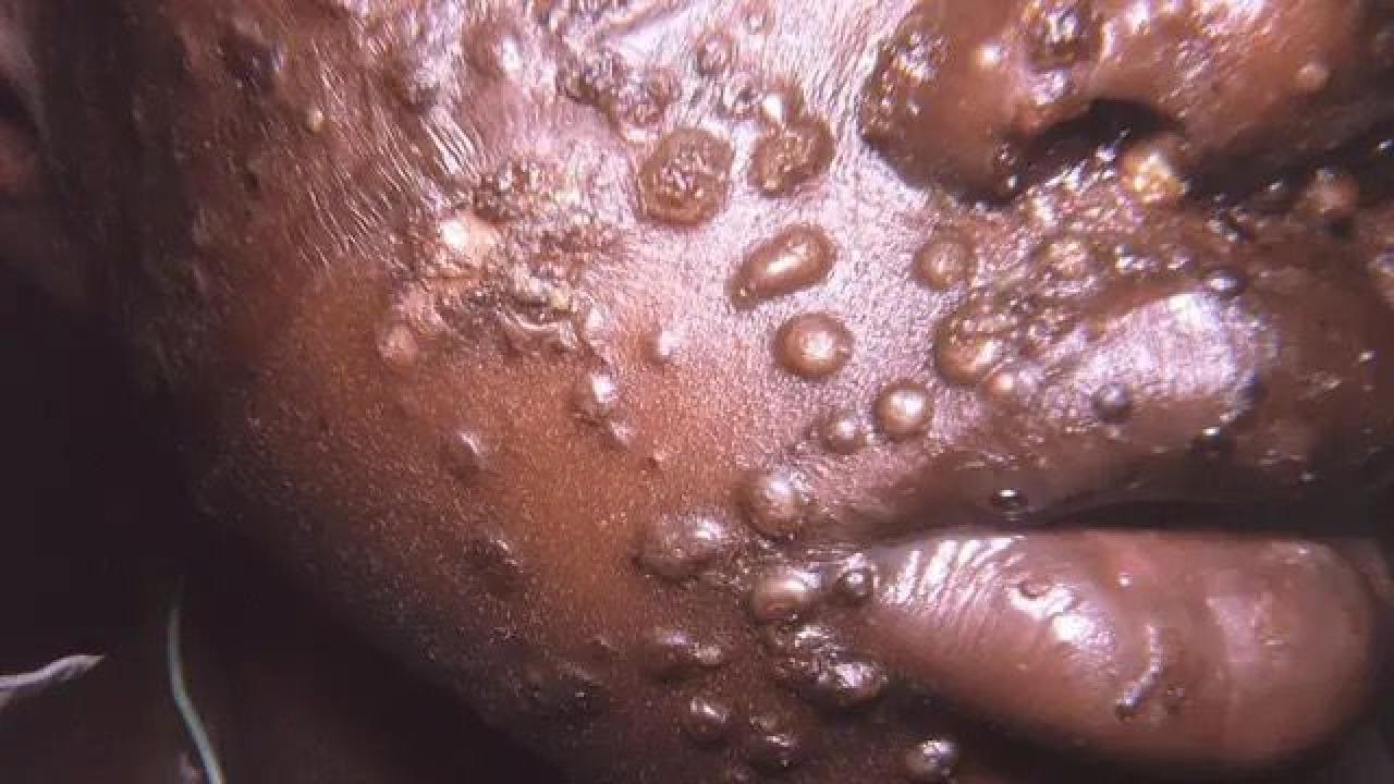 Un enfant souffrant de variole du signe (image d’illustration)