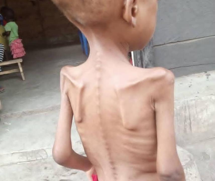 Un enfant orphelin vivant avec la malnutrition à Kasindi-Lubirihya dans l'orphelinat Tukinge Yatima