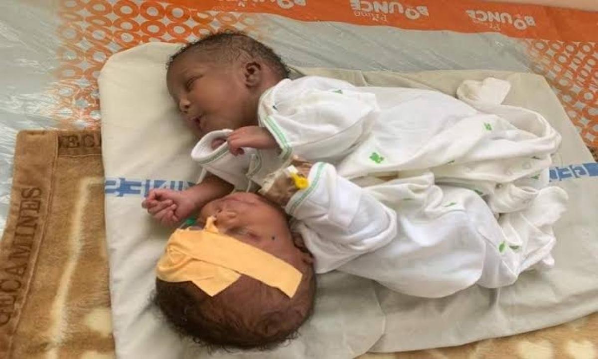 Des bébés siamois [photo d'illustration]